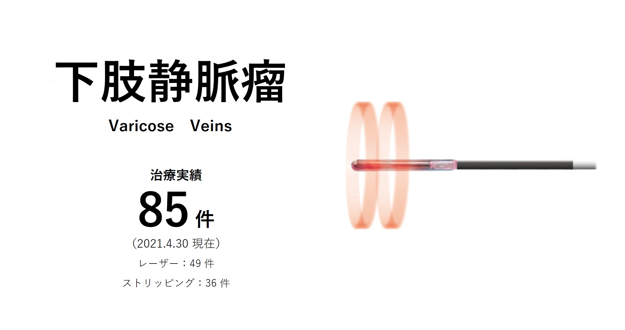下肢静脈瘤